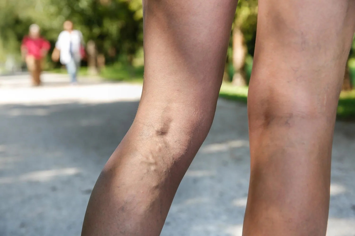 varices douloureuses et araignées sur les jambes de womans