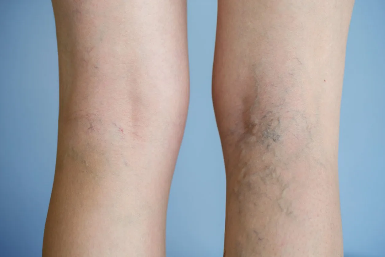 painful varicose veins (spider veins, varices) on a severely affected leg ageing, old age disease, aesthetic problem concept