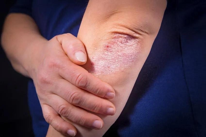 psoriasis sur fond noir de coude