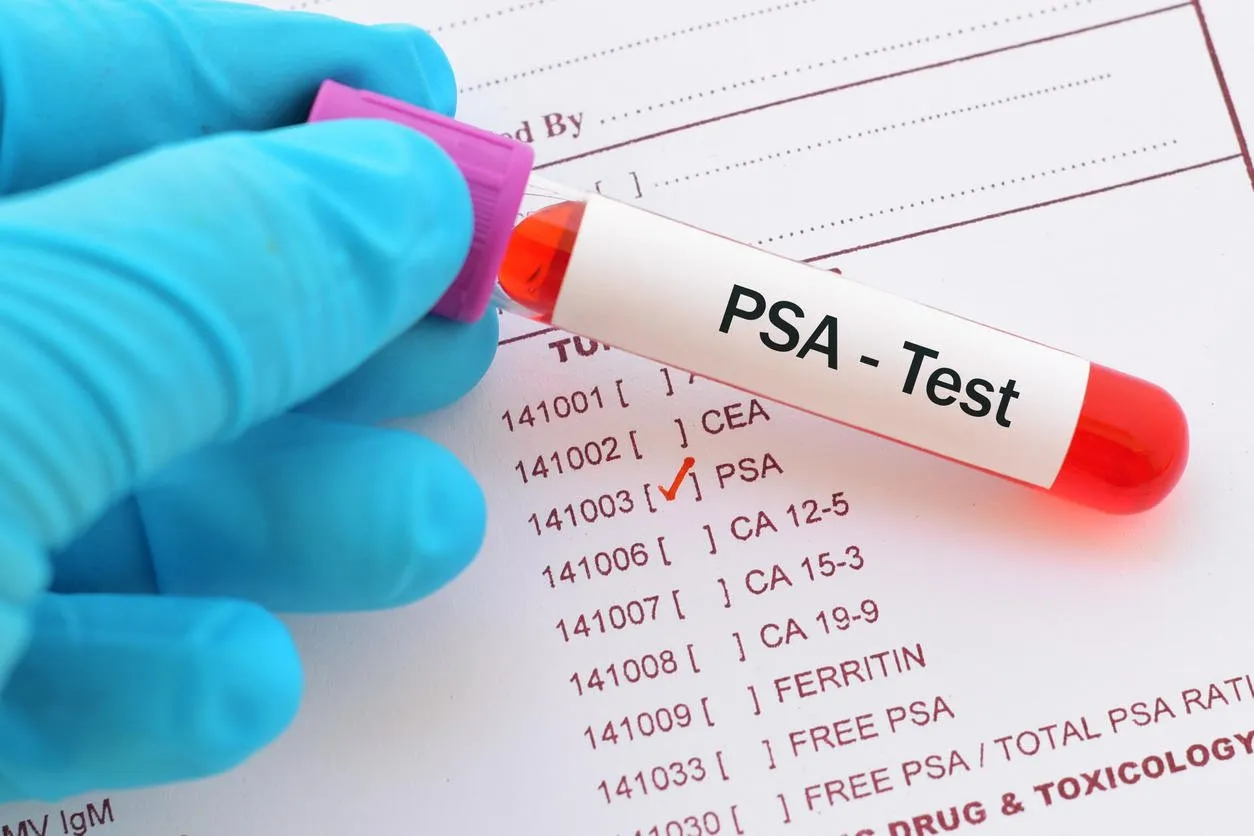 test tube with blood sample for psa test, prostate cancer diagnosis