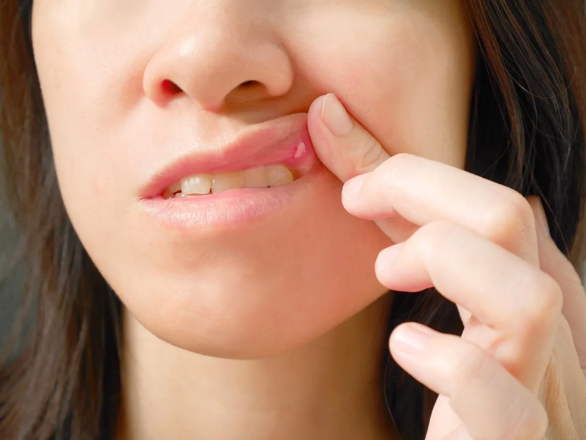 canker sore on woman upper lip