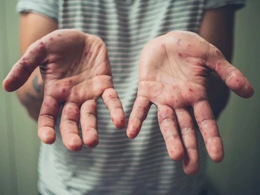 a young man is showing his hands with spots and rash from hand foot and mouth disease