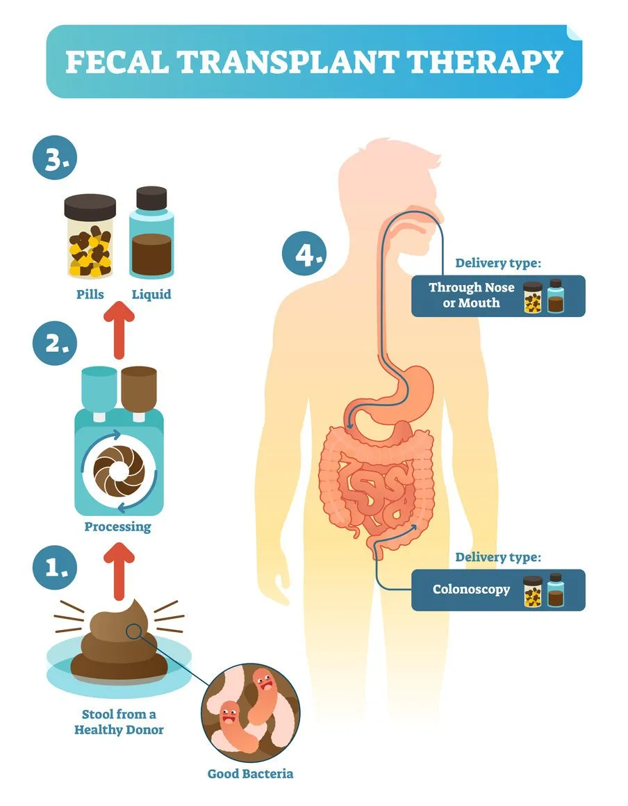 fecal transplant therapy, procedure steps diagram, vector illustration healing human digestive microflorataking healthy stool from donor, processing and delivering to human body