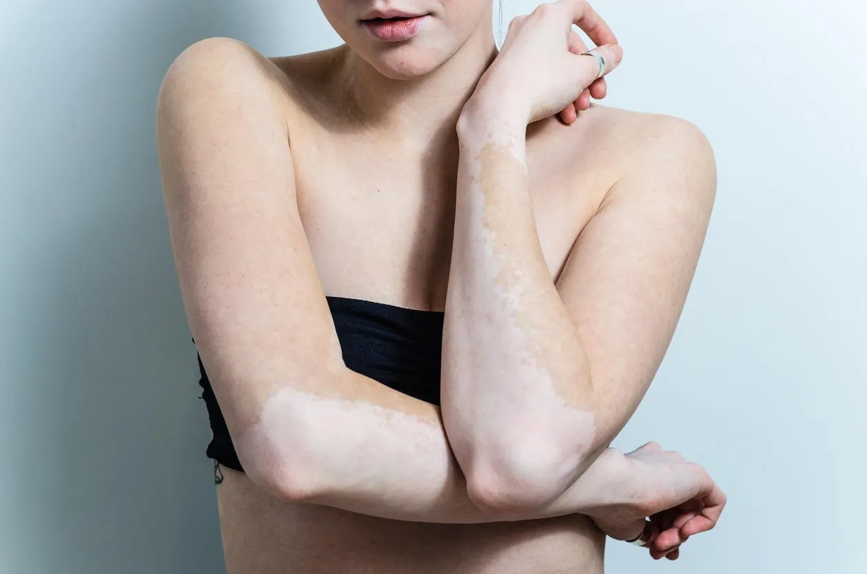 vitiligo affected skin parts on the arms of young woman with eyes closed on the gray backgrounds