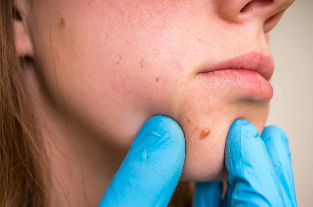 woman with birthmark on her face, skin tags removal - cosmetic surgery