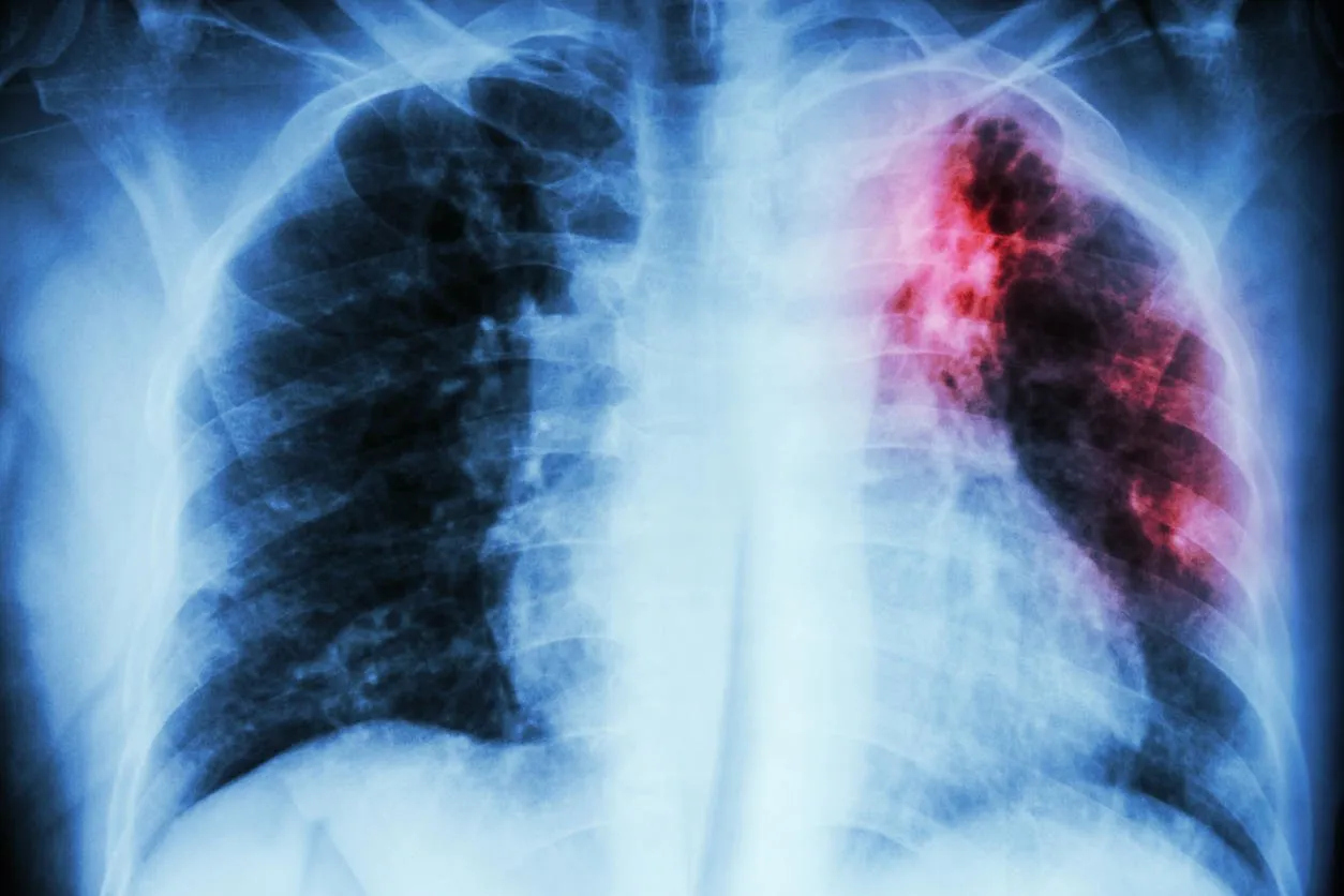 pulmonary tuberculosis  chest x-ray   interstitial infiltration at left upper lung due to mycobacterium tuberculosis infection
