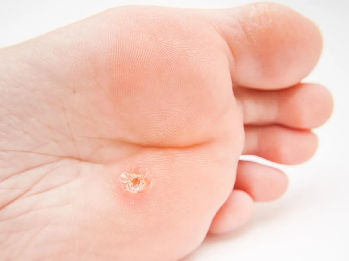 person with callus located under foot, close to toes towards white