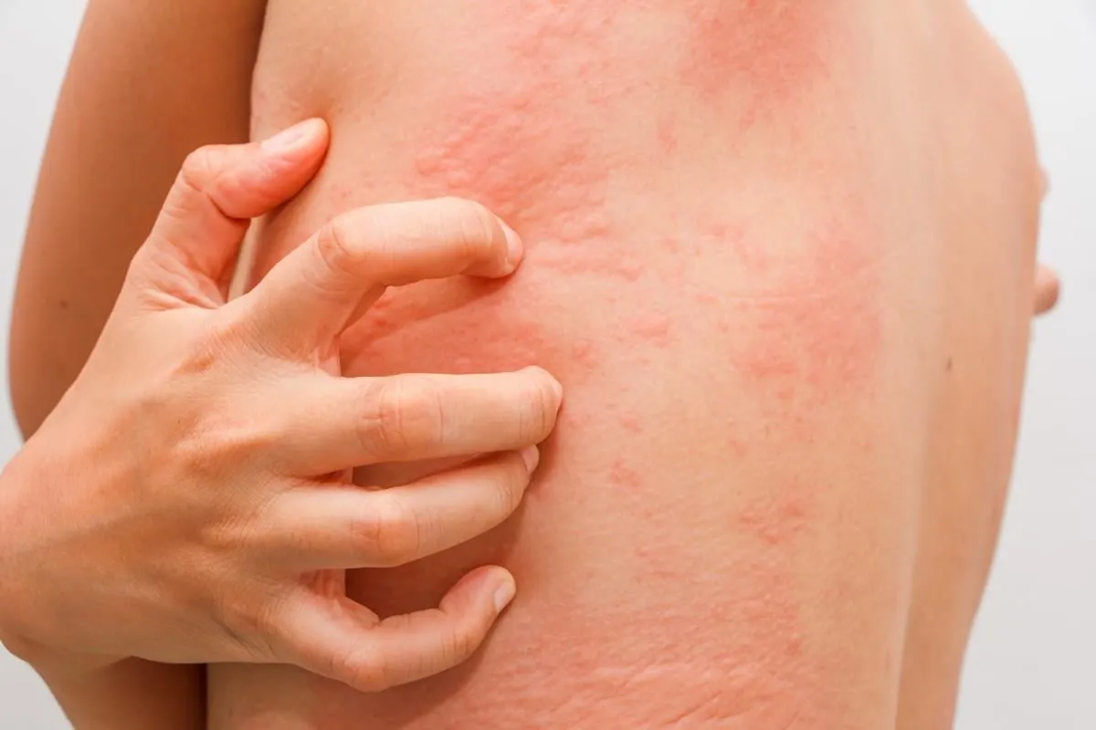 women with symptoms of itchy urticaria
