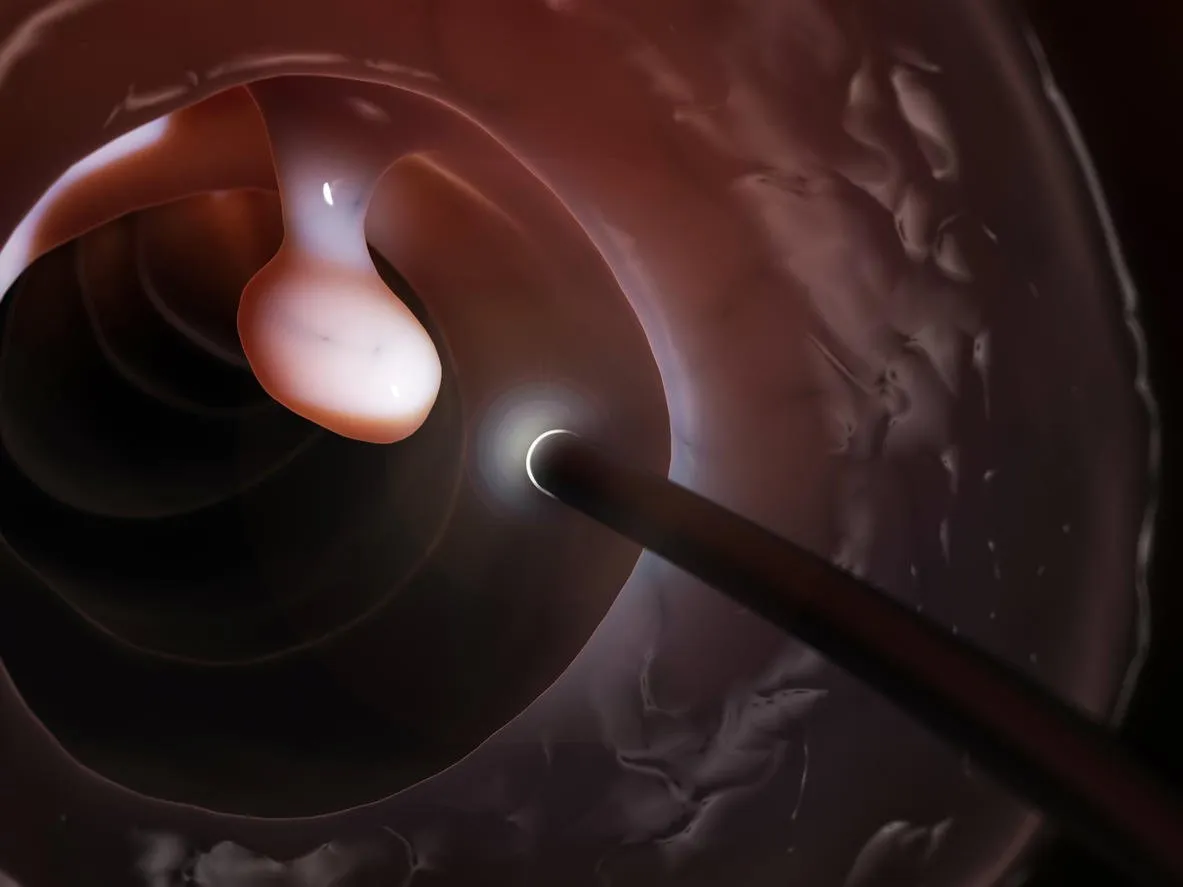 3d rendered illustration of a colonoscopy