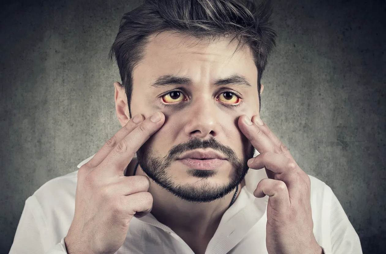 hepatic disease sick man looking in a mirror has yellowish eyes as sign of possible liver infection or other disease