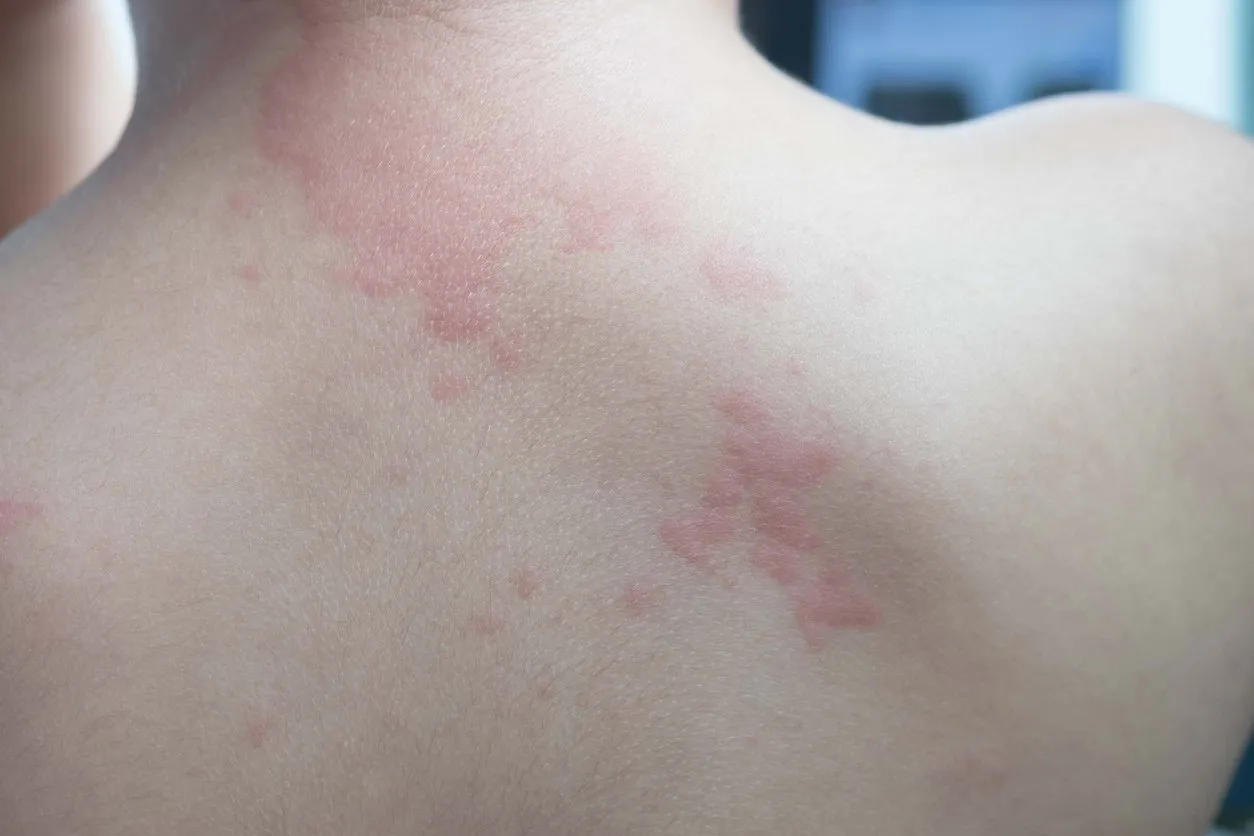close up image of boy's body suffering severe urticaria, nettle rash