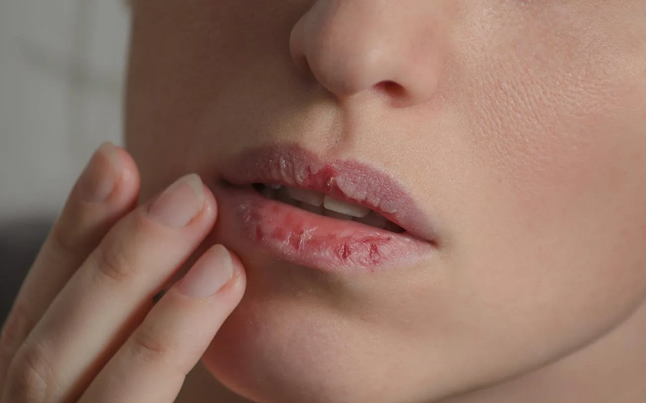 dermatillomania skin picking woman has bad habit to pick her lips harmful addiction based on anxiety stress and dry lips excoriation disorder sick cracked damaged tissue
