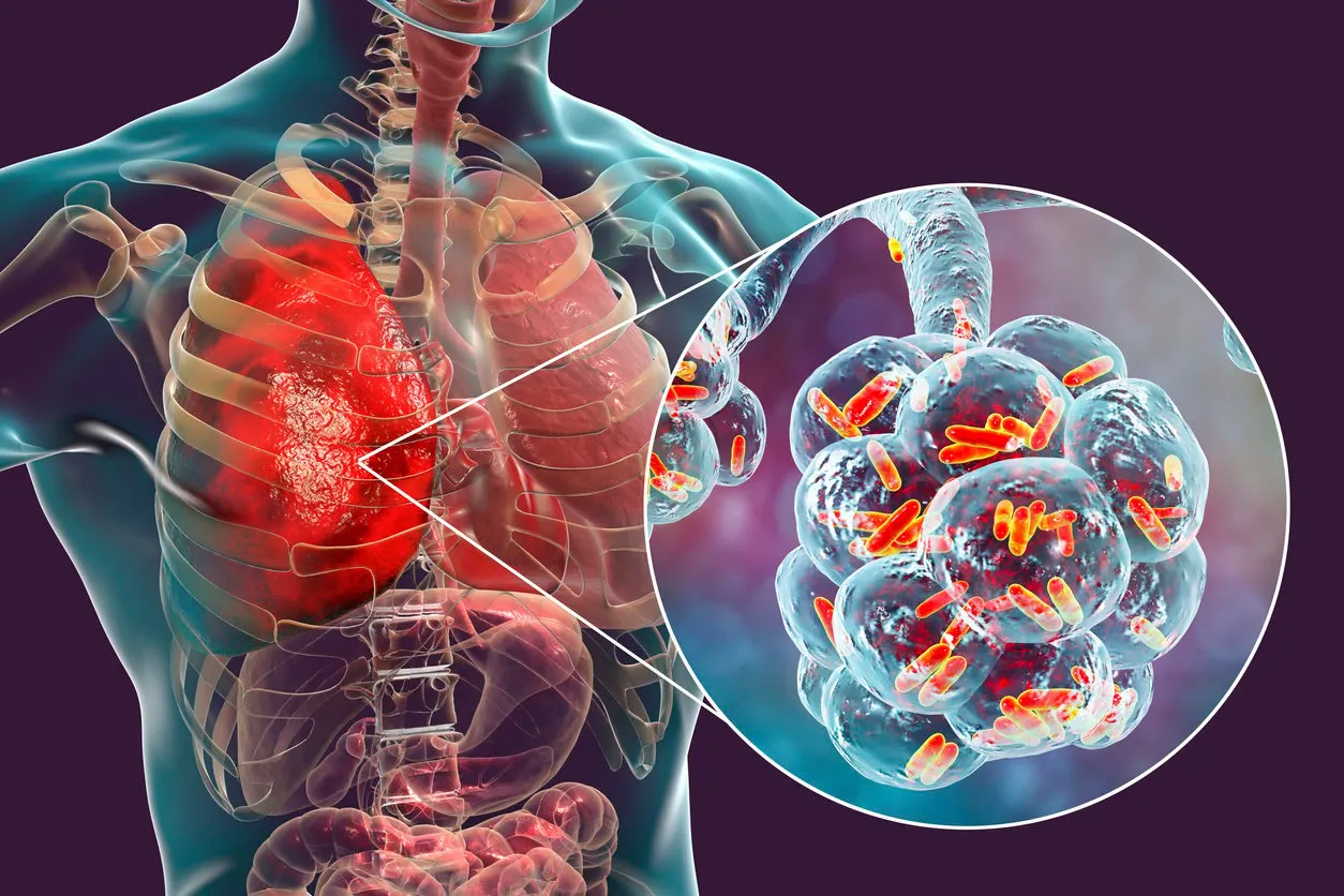 bacterial pneumonia, medical concept 3d illustration showing rod-shaped bacteria inside alveoli of the lung