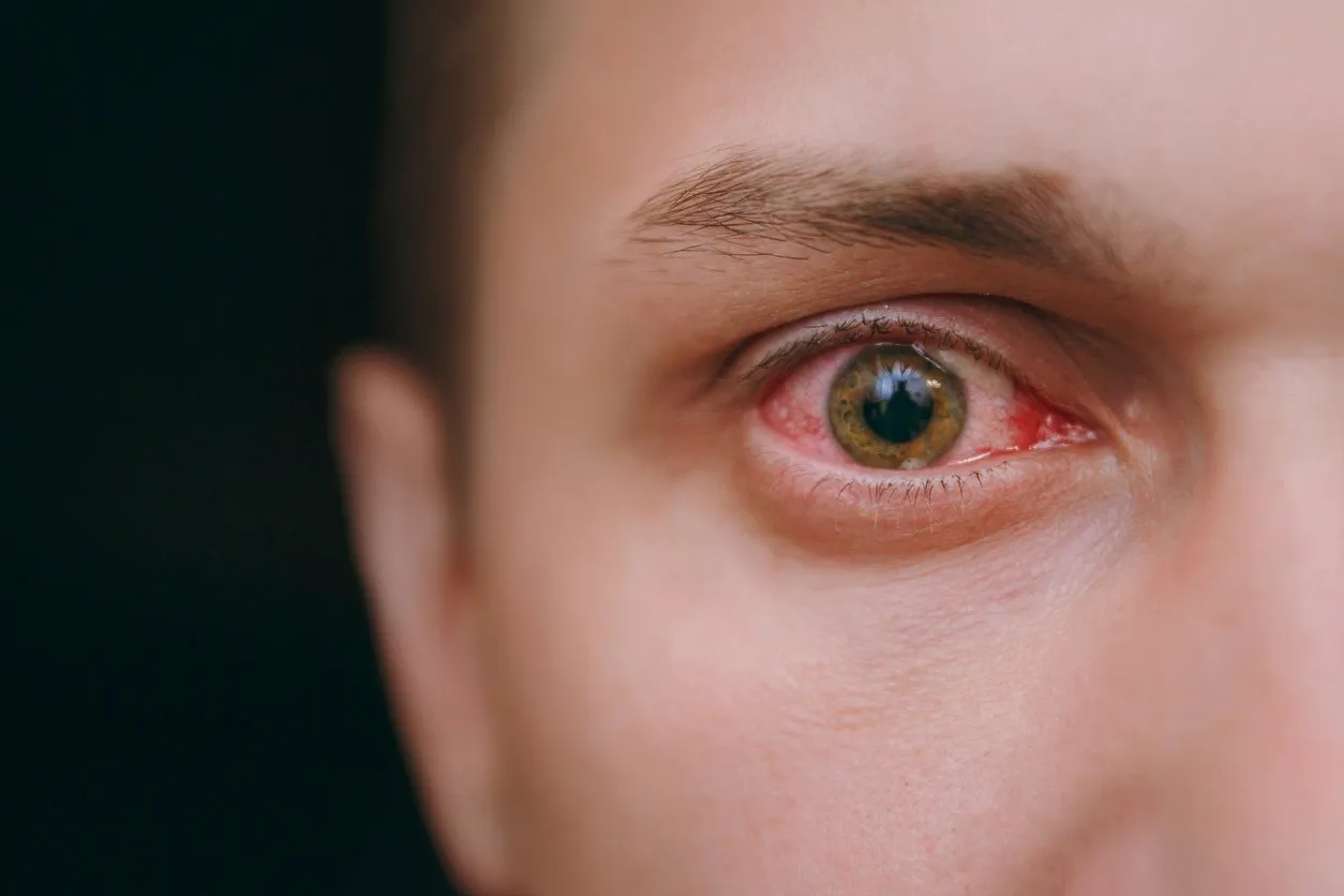 the close up of one annoyed red blood eye of a man affected by conjunctivitis