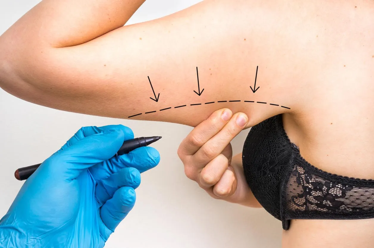 plastic surgery doctor draw line on patient arm - cosmetic surgery concept