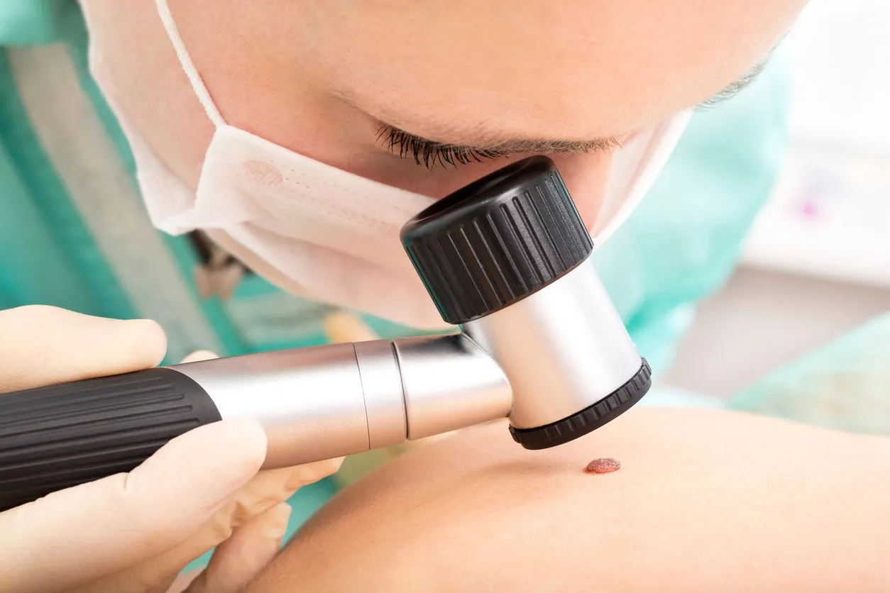 dermatologist studies birthmark using dermatoscope