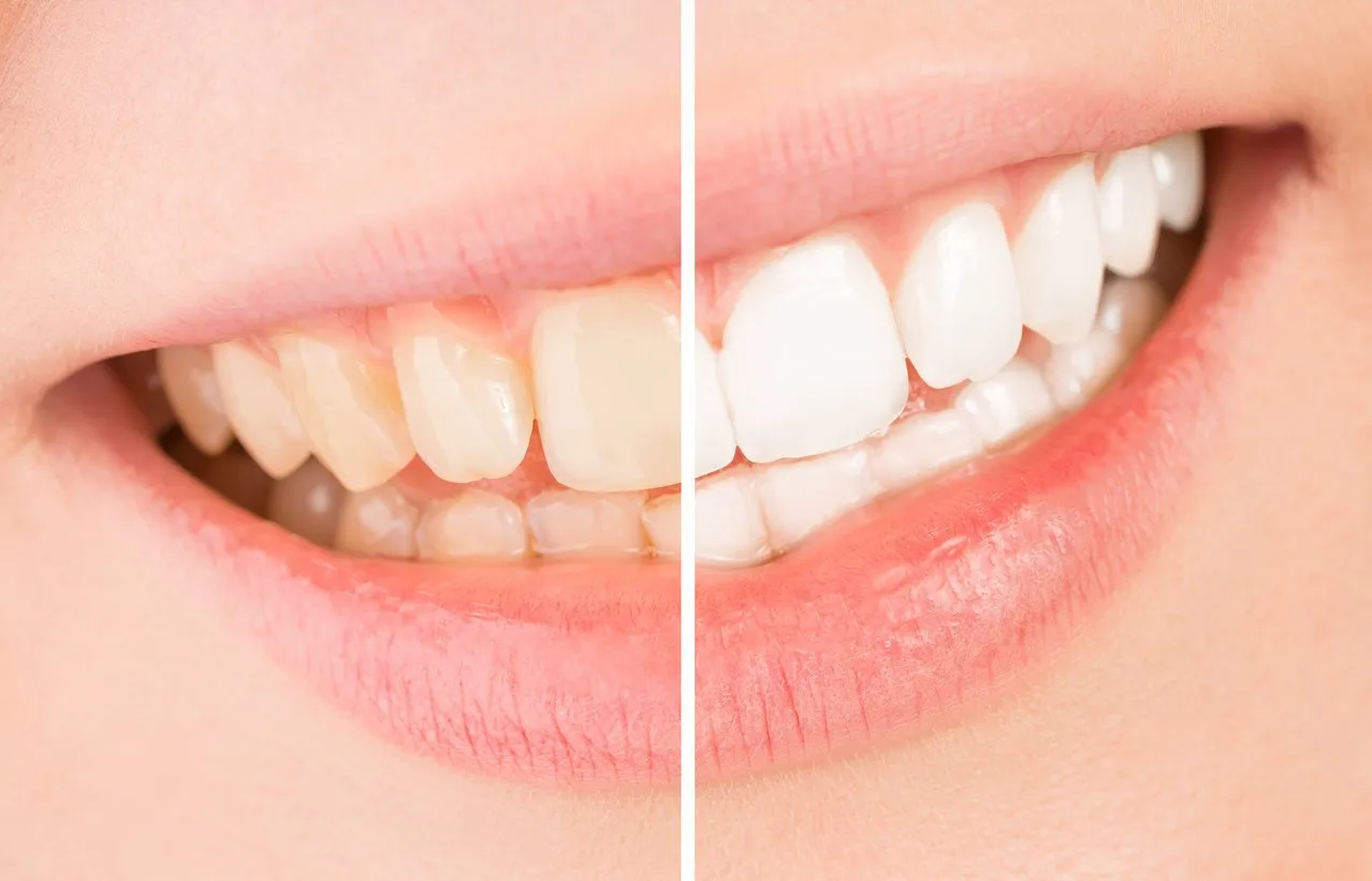 whiten - a beautiful smile and teeth whitening treatment before and after