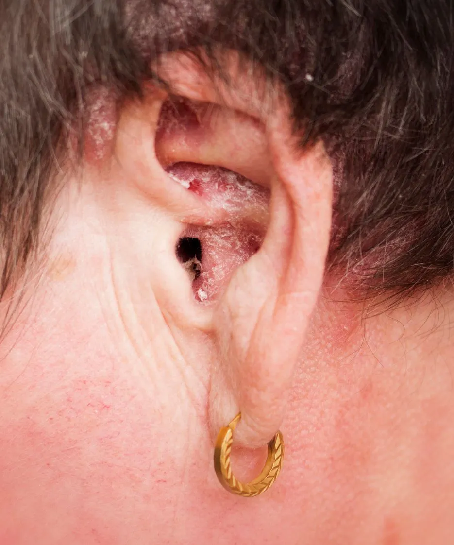 detail of psoriasis vulgaris, skin disease