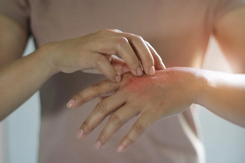 healthcare and medical concept female scratching the itch on her hand, cause of itching from skin diseases, dry skin, allergy, chemical, allergic to detergent or dishwashing liquid and dermatitis, insect bites, burned, drug health problem