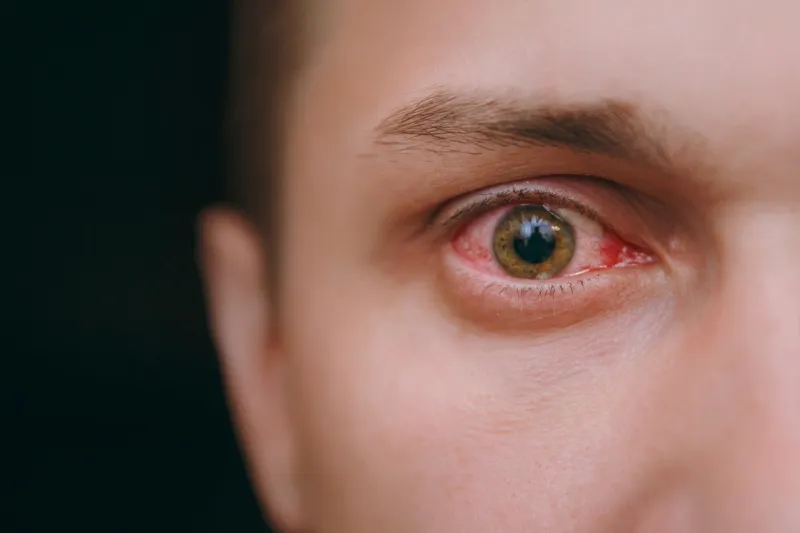 the close up of one annoyed red blood eye of a man affected by conjunctivitis