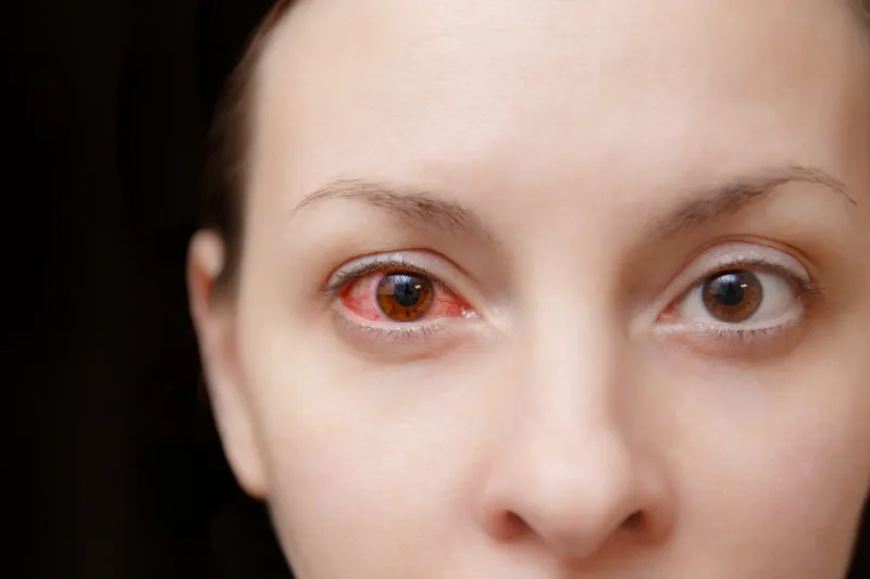 close up of one annoyed red blood and health eye of female affected by conjunctivitis or after flu, cold or allergy concept of disease and treatment copy space for advertisement with place for text