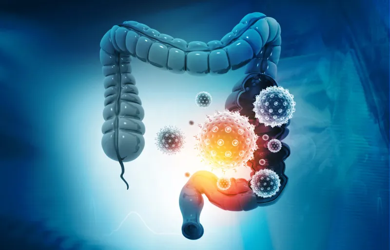 colon cancer, bacteria, viruses in sick unhealthy intestine 3d illustration