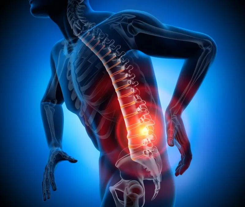 3d rendering - starke schmerzen in der wirbelsäule und bandscheiben - bandscheibenvorfall