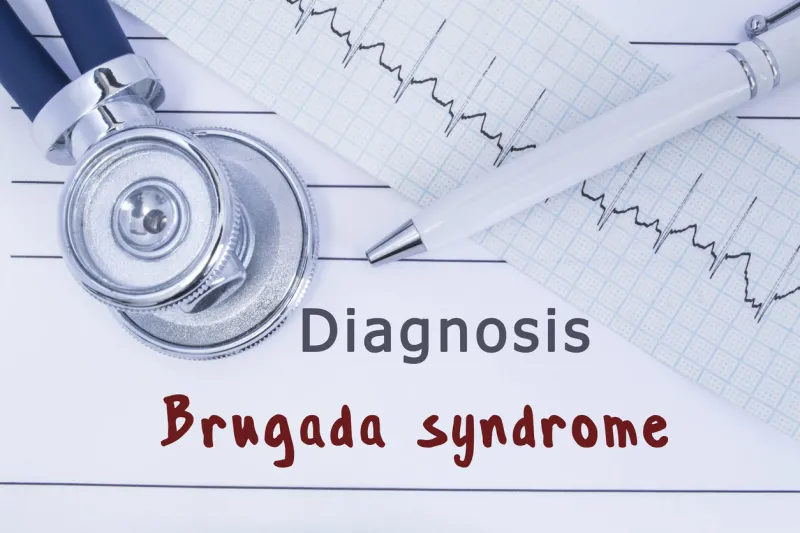 diagnosis brugada syndrome stethoscope or phonendoscope together with type of ecg lie on medical history with title diagnosis brugada syndrome medical concept for cardiology and internal medicine