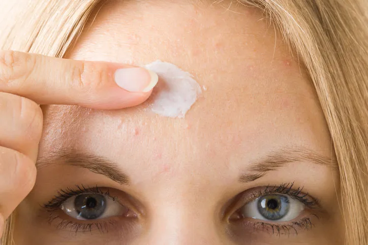 young woman finger applying medical ointment on small pimples rash on forehead skin closeup front view
