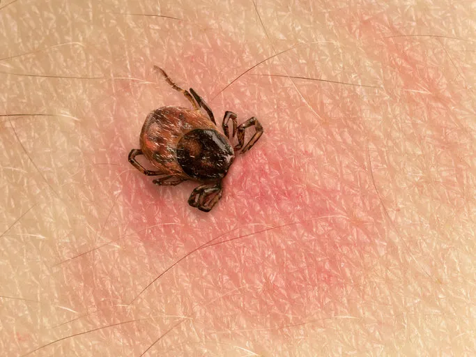 tick with its head sticking in human skin, red blotches indicate an infection