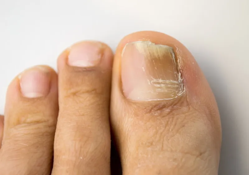 onychomycosis with fungal nail infection