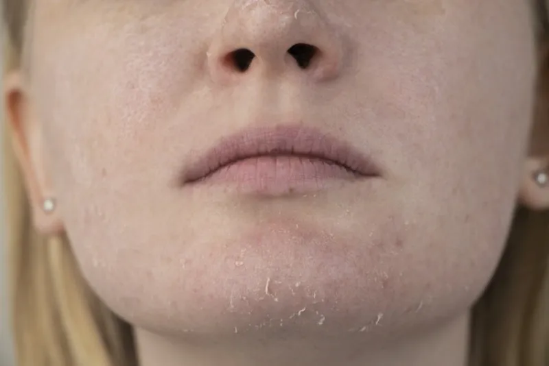 a woman examines dry skin on her face peeling, coarsening, discomfort, skin sensitivity patient at the appointment of a dermatologist or cosmetologist, selection of cream for dryness