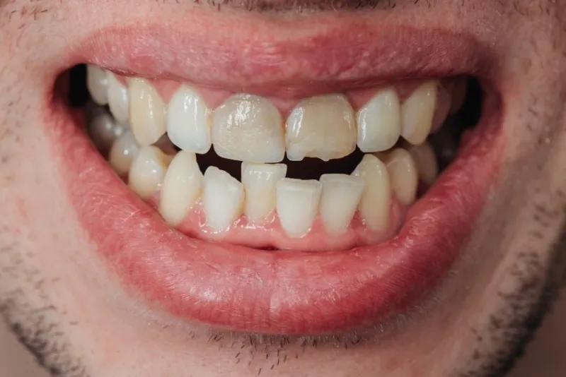 crooked teeth extended tooth with a chip