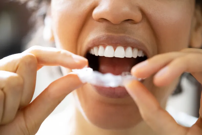 clear aligner dental night guard for teeth