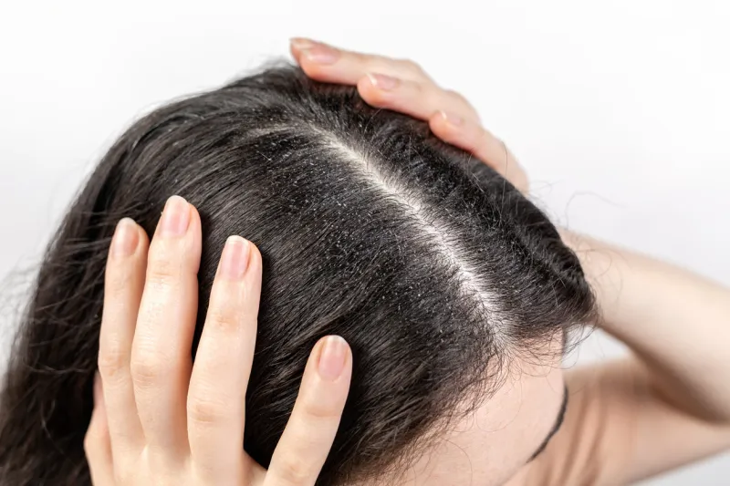 the woman holds her head with her hands, showing a parting of dark hair with dandruff close up the view from the top zoomed partingwhite background the concept of dandruff and pediculosis