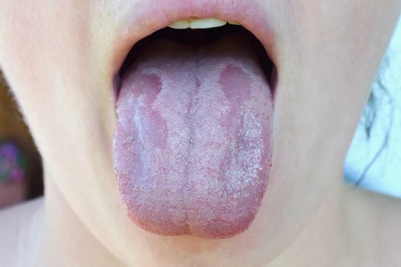 oral candidiasis or oral trush ( candida albicans), yeast infection on the human tongue close up, common side effect when using antibiotics or another medicaments