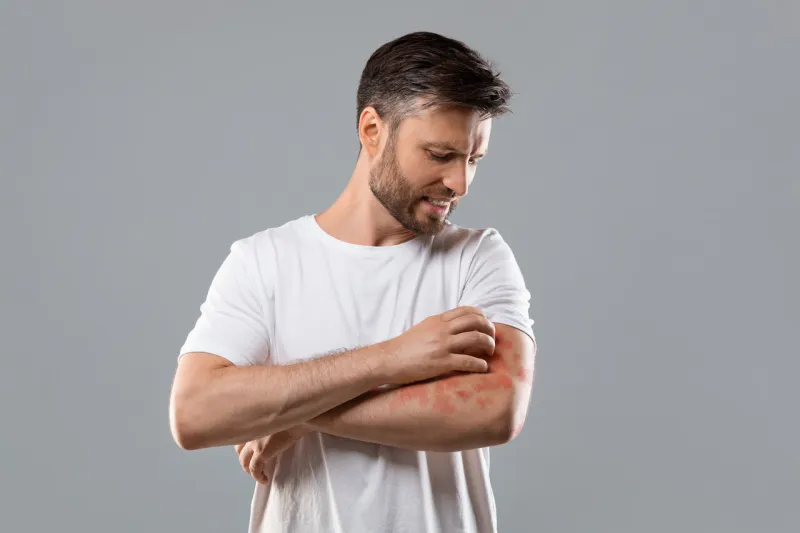 dermatitis, eczema, allergy, psoriasis concept annoyed middle-aged man in white t-shirt scratching itch on his arm, grey studio background bearded man itching rash on his elbow, copy space