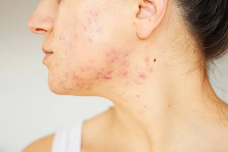 acne on the face of young women improper therapy has led to a severe form of chronic inflammation face-image