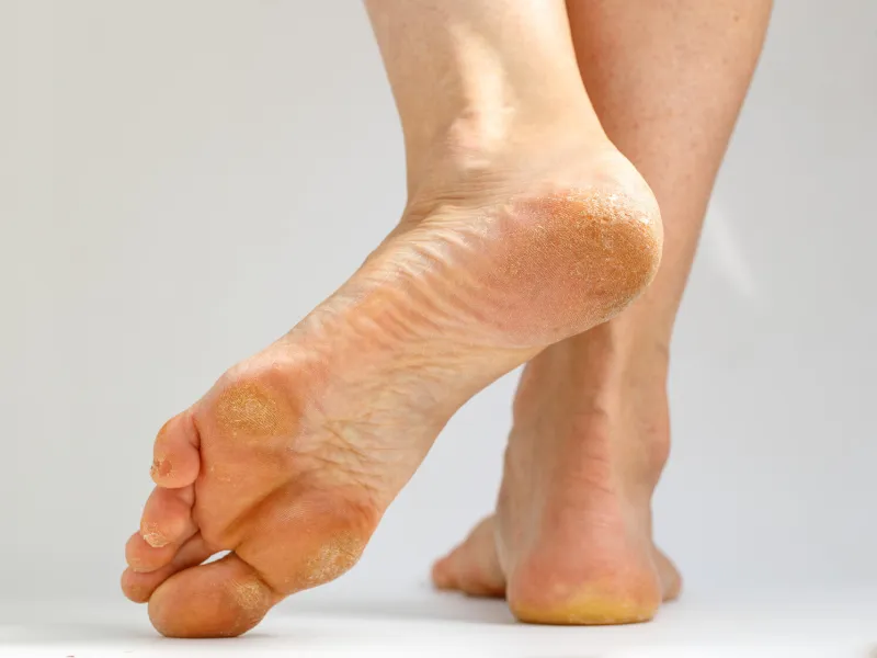 dry skin, plantar callosity and flakes on the female heel and feet sole close up on white background image for medical purposes