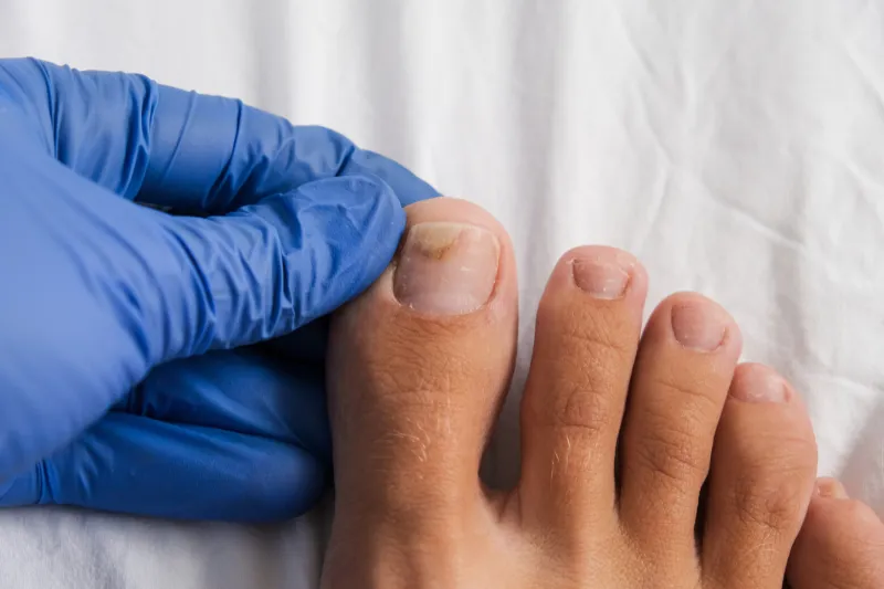 a doctor examines bare foot with onycholysis on a toenail after damaging with tight shoes or using gel-lacquer
