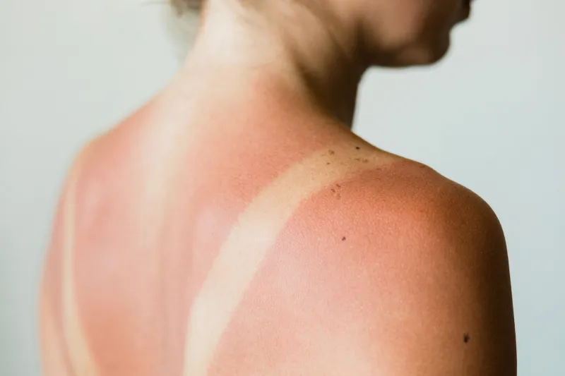 close-up of a sunburn marks on a woman's back