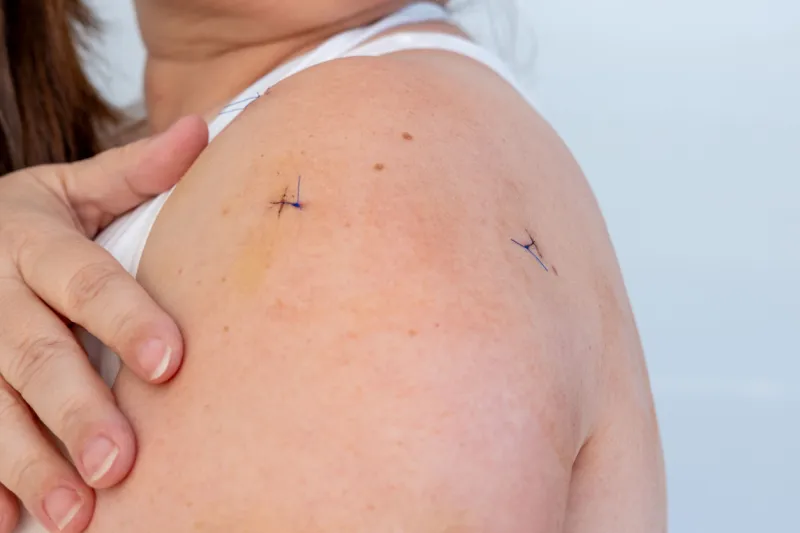 Douleurs post opératoire