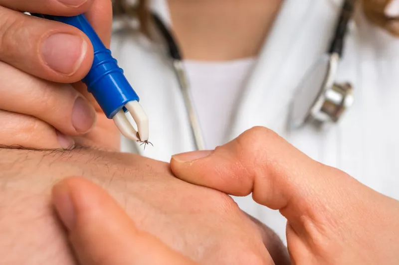 female doctor removing a tick with tweezers from hand of patient encephalitis, borreliosis and lyme disease