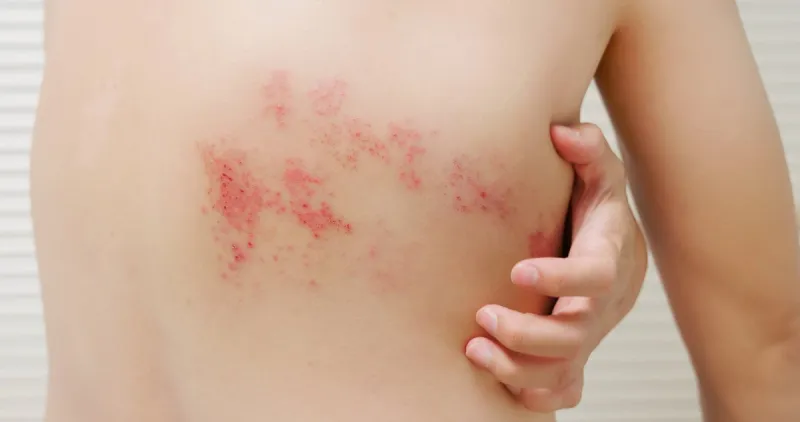 man with shingles disease on skin and he feel very painful