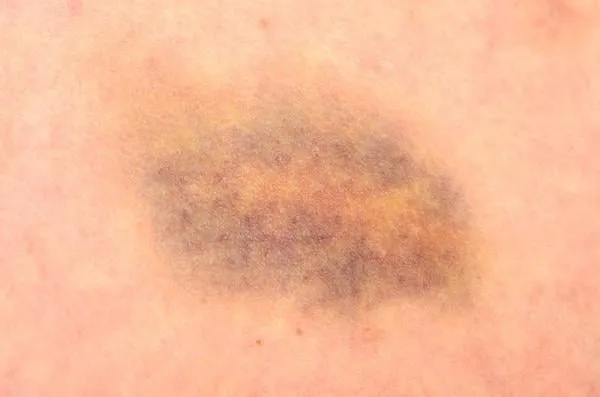 gros plan d'une ecchymose sur une ecchymose