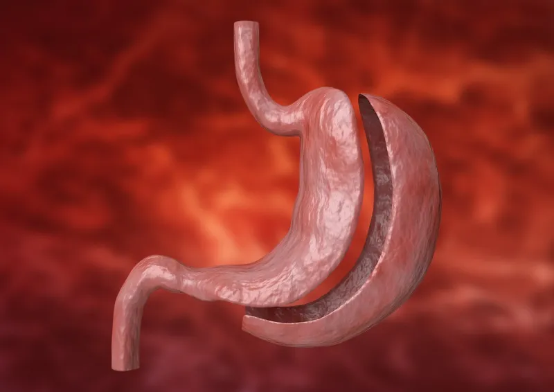 vertical sleeve gastrectomy bariatric surgery with reduction of the size of the stomach for weight loss and loss of body weight 3d rendering