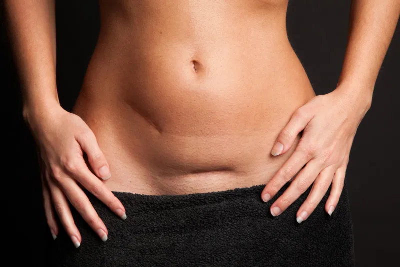ventre d'une jolie femme avec des cicatrices