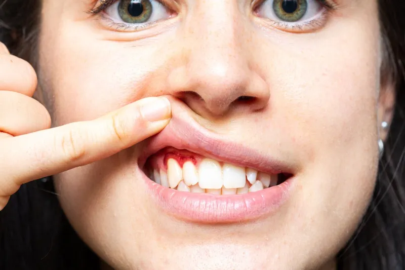 closeup of a girl with bleeding gums lifting her lip with her finger macro of a woman's mouth with red gums inflammation caused by gingivitis