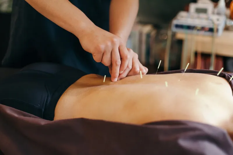 acupuncture session in a japanese medical study young woman is lying down while the operator inserts the needles in the back of the patient