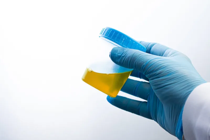 urine analysis in the laboratory medical urine test urine sample for laboratory analysis